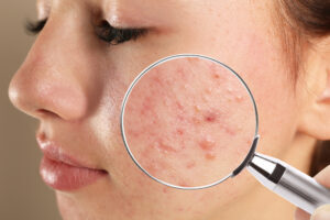 Treatment for eczema Stockbridge GA