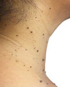 dermatologist, remove skin tag, National healthCare Center, Stockbridge, GA