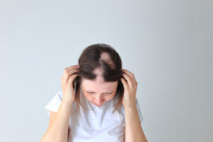 alopecia in women, dermatologists for alopecia, alopecia treatment Fayetteville, GA